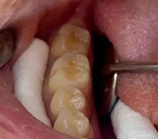Before and after dental crown reconstruction and bite restoration at Smile Rehab Center in Cancun